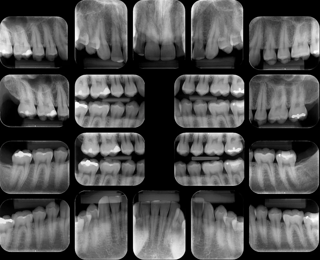 Radiografia Periapical - Easy Radiologia